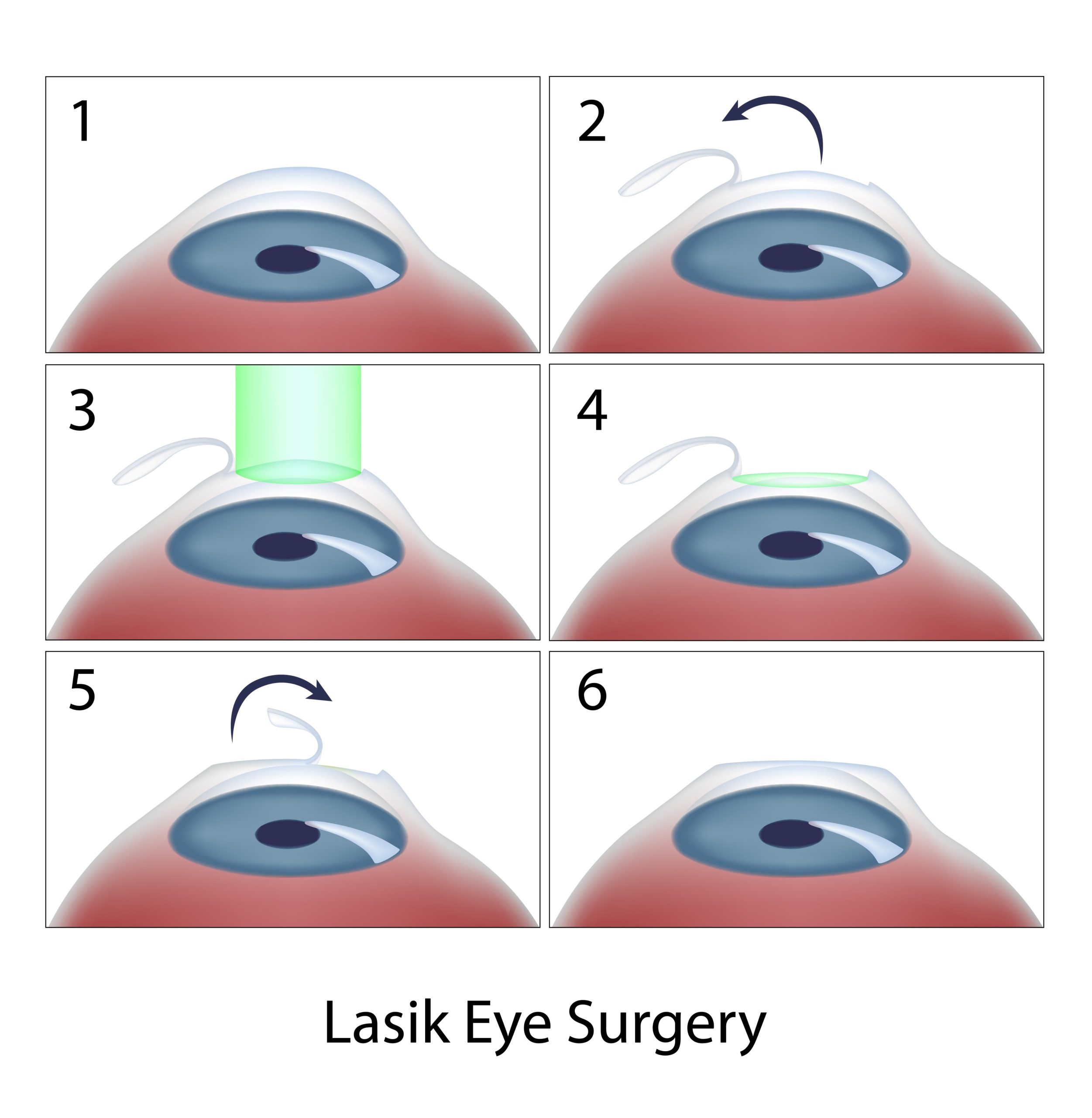 Cirurgia Refrativa