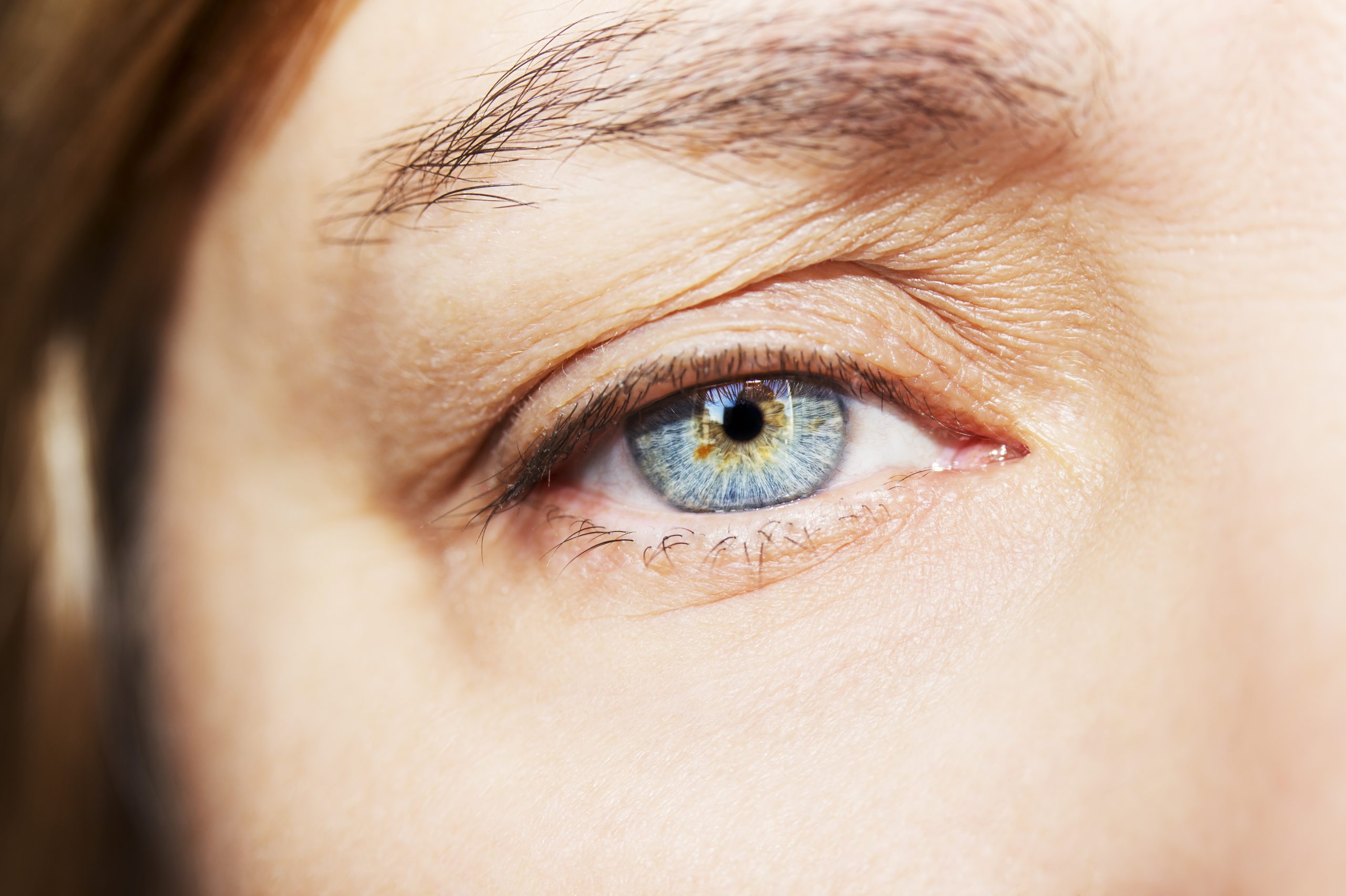 dermatocalse excesso de pele